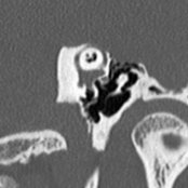 Transverse oblique bone CT reformation displays the dehiscent roof of the superior semicircular canal  to best advantage by showing the entire extent of the dehiscence in a single image. Symptomatic patients typically present with sound-induced vertigo &/or nystagmus, i.e., Tullio phenomenon.