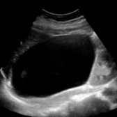 Sagittal US in a 35-year-old woman shows a > 10-cm right suprarenal cyst . Real-time examination and a follow-up MR (not shown) confirmed simple extrarenal-adrenal cyst that was subsequently resected. An epithelial cyst (a rare subtype of adrenal cysts) was shown at histology.