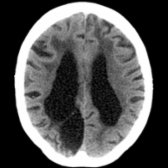 Axial NECT in a 81-year-old woman with multi-infarct dementia shows cystic encephalomalacia in the right parietal lobe  due to an old infarct. There is marked volume loss with ventricular enlargement. There are confluent white matter hypodensities  consistent with arteriolosclerosis and lipohyalinosis.
