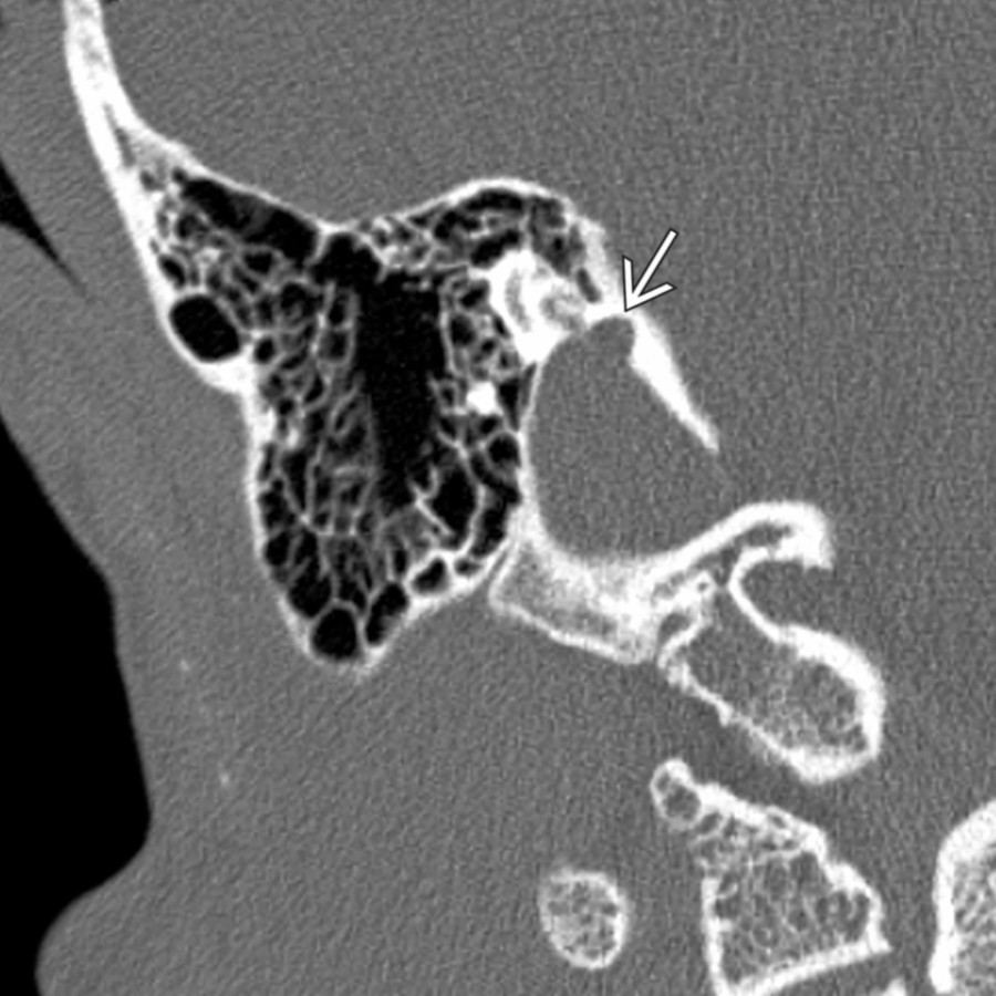 Coronal bone CT demonstrates a jugular bulb diverticulum as a superomedial projection off the top of the jugular bulb . These lesions are often asymptomatic but can be the cause of pulsatile tinnitus.