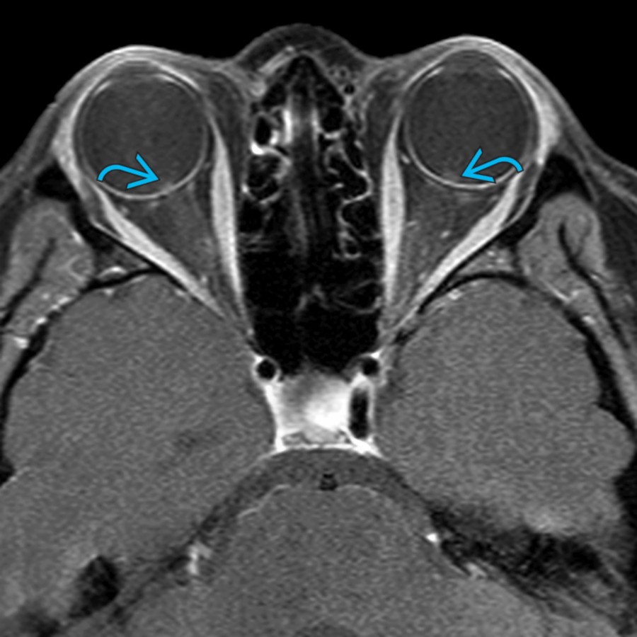 Axial T1 C+ MR in the same patient shows subtle enhancement , as well as protrusion of prelaminar optic nerves bilaterally.