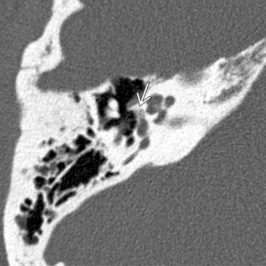 Axial bone CT demonstrates a subtle active otosclerotic plaque along the anterior margin of the oval window . This is the location of the fissula ante fenestram where fenestral otosclerosis begins.