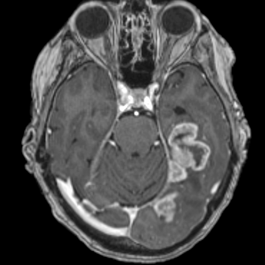 Axial T1 C+ MR shows an irregular ring-enhancing mass in the left medial temporal lobe and occipital lobe. This was a glioblastoma, IDH-wildtype at biopsy.