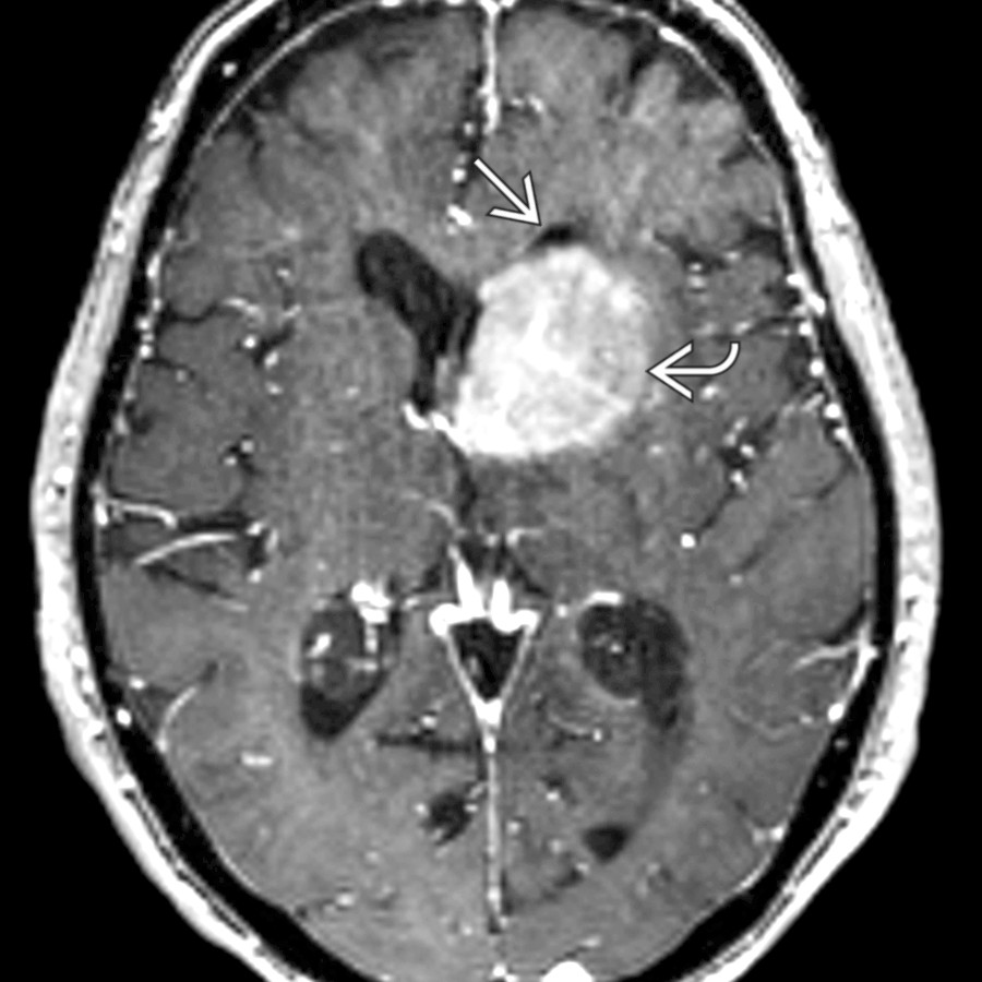 Axial T1WI C+ MR shows compression of the left frontal horn  by a large, periventricular, enhancing mass , primary CNS lymphoma. Extrinsic mass effect is a common cause of ventricular asymmetry.
