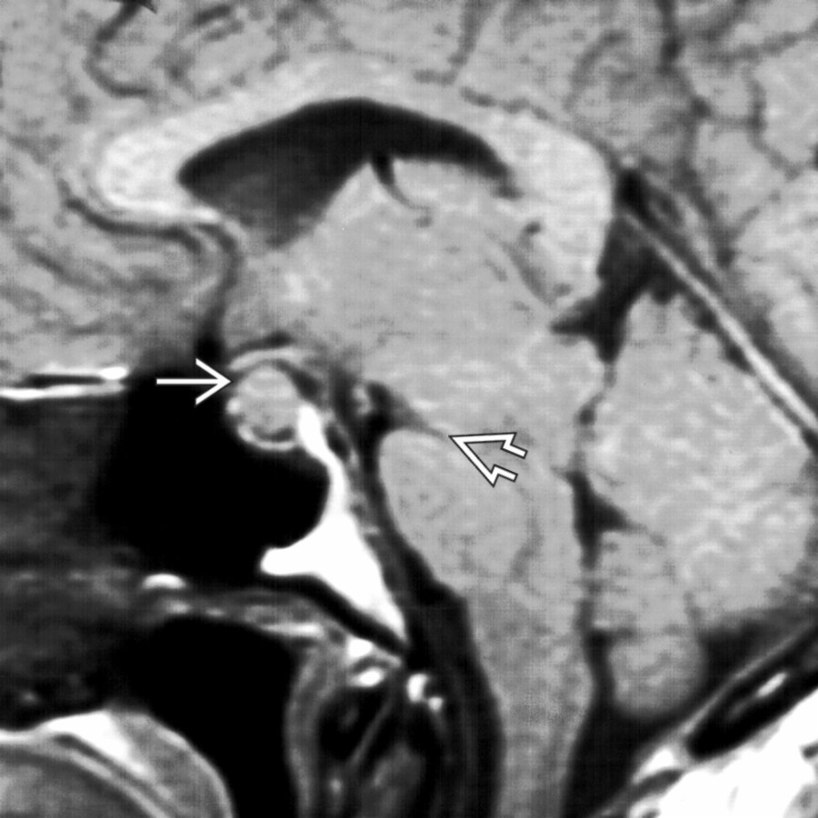 Sagittal T1WI MR shows a rounded, "plump" pituitary gland , often seen in IH. Note the effaced suprasellar cistern with optic chiasm draped over the pituitary gland, classic "slumping" midbrain, with decreased angle between the pons and midbrain .