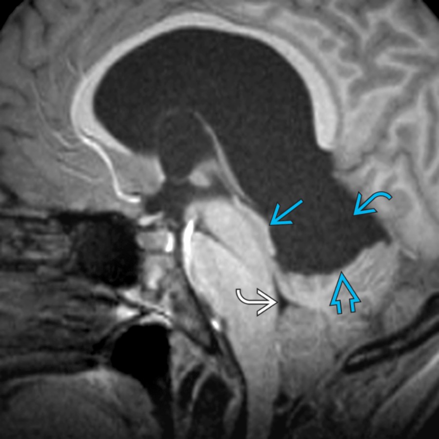Sagittal T1 MR in the same patient demonstrates the large medial atrial diverticula , which herniates inferiorly through the tentorial incisura into the posterior fossa, compressing the vermis , tectal plate , aqueduct, and 4th ventricle .