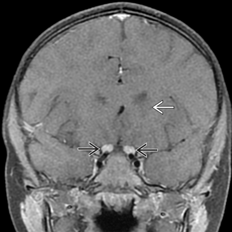 Coronal T1 C+ FS MR in the same patient shows no enhancement in the slightly hypointense basal ganglia lesion   , but avid enhancement of both cisternal optic nerves  (bilateral anterior segment optic neuritis). Contrast is essential for assessing the optic nerves for signs of neuritis.