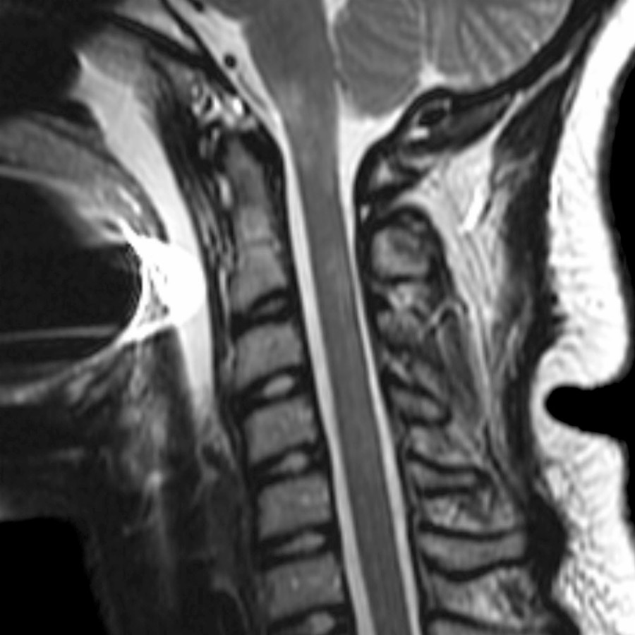Sagittal T2 MR in a 9-year-old with optic neuritis shows multiple ill-defined hyperintensities in the medulla & cervical cord. Subsequent serum testing revealed antibodies to aquaporin 4, confirming a diagnosis of neuromyelitis optica spectrum disorders (NMOSD).