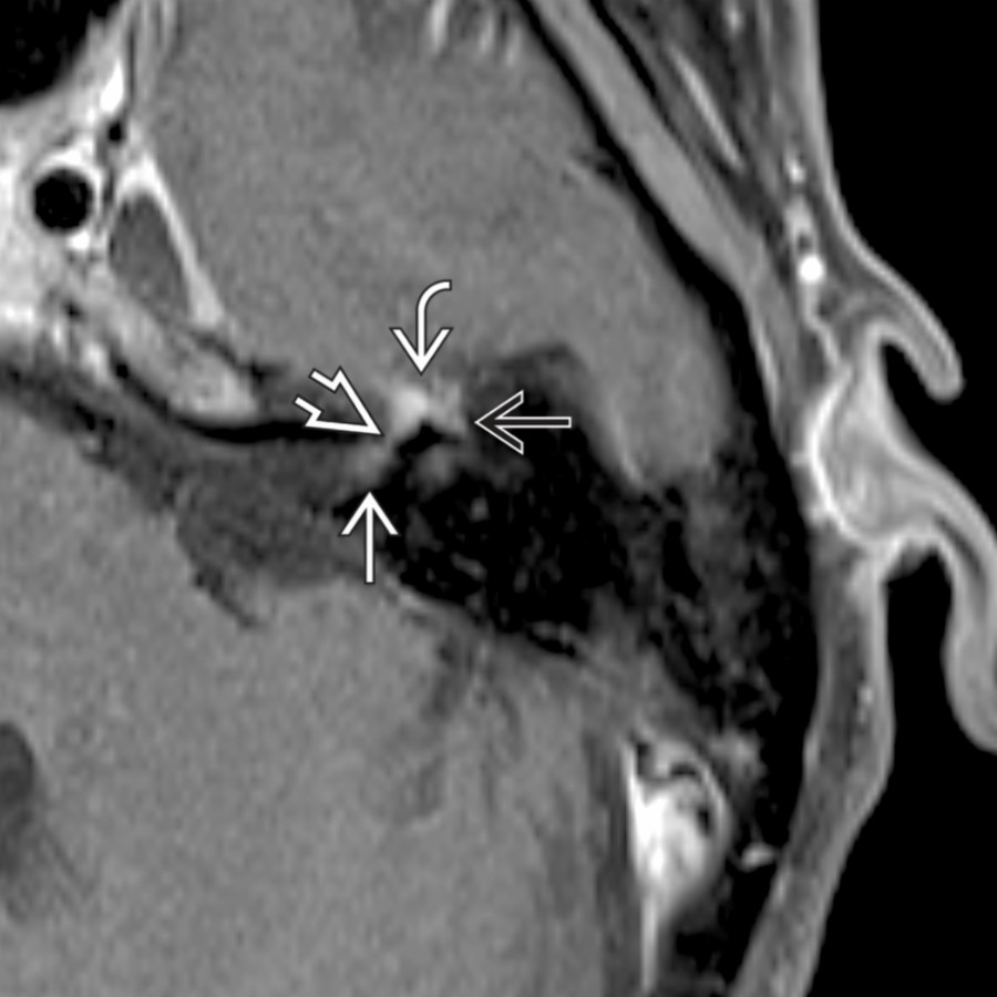 Axial T1 C+ FS MR in a patient with Bell palsy shows the classic faint, tuft-like enhancement at the fundus of the IAC , which extends as a linear enhancement along the labyrinthine segment , anterior genu , and anterior tympanic  segments of the facial nerve.