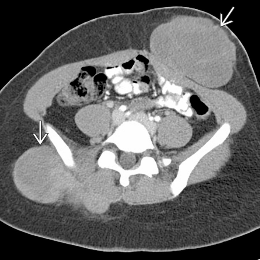 Axial CECT shows multiple large, hypodense masses  in the pelvic subcutaneous soft tissues in a patient with known familial polyposis, representing desmoid tumors.