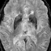 Axial SWI MR in an 85-year-old patient demonstrates marked fairly symmetric hypointensity in the basal ganglia  related to normal mineralization with age. Putaminal hypointensity on SWI is less prominent until 8th decade.
