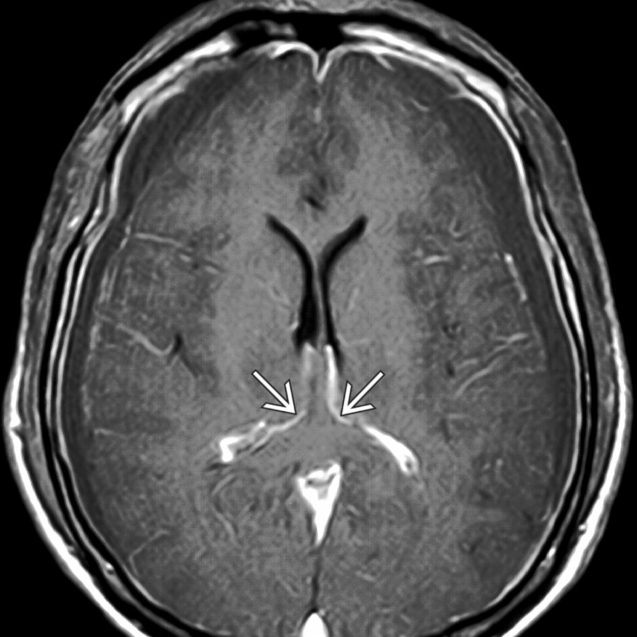 Axial T1WI C+ MR in the same patient shows diffuse dural enhancement, hypodense extraaxial fluid collections, and small ventricles with medial deviation of the choroid and internal cerebral veins  caused by midbrain descent.