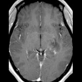 Axial T1 C+ MR in the same patient 4 days after IV steroid therapy shows almost complete resolution of the enhancement .