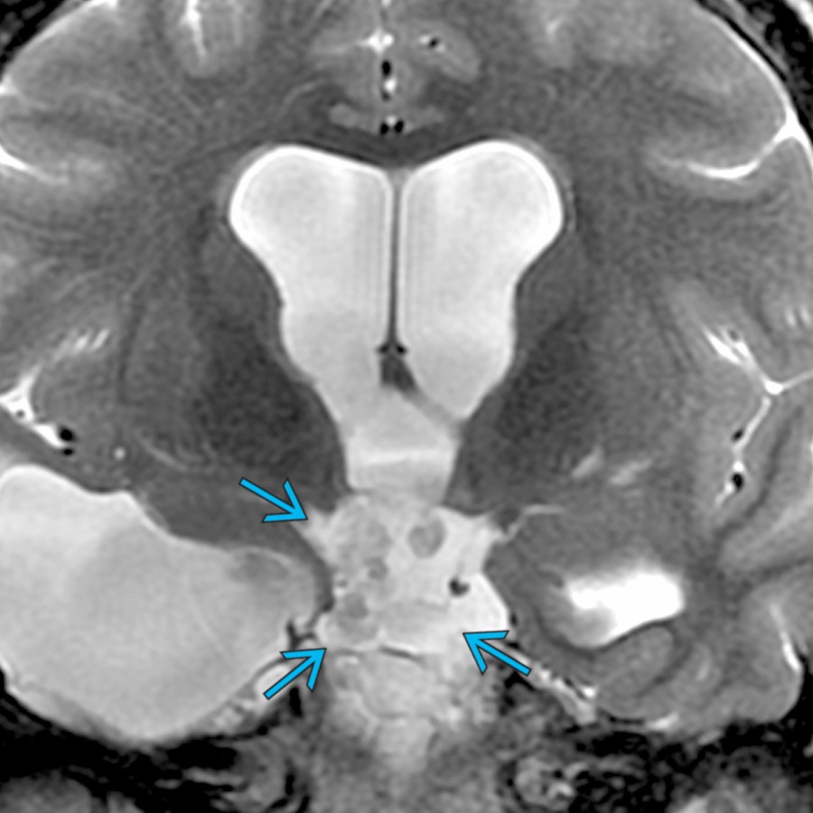 Coronal T2WI MR shows an epidermoid cyst in the suprasellar cistern  with a lobulated appearance and associated ventriculomegaly. These benign cysts classically show restricted diffusion and lack suppression on FLAIR sequences. Surgical resection is the treatment of choice.