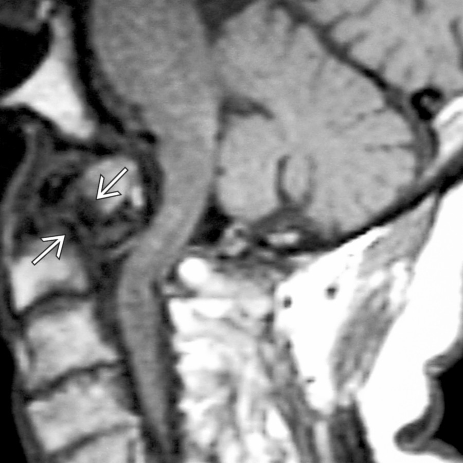 Sagittal T1WI MR shows a nonunited fracture of dens , so-called os odontoideum. Posterior displacement of the ossicle has resulted in cord impingement.