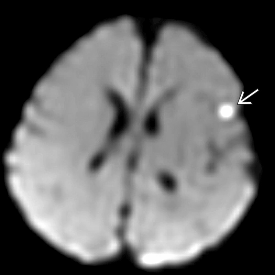 Axial DWI MR in the same patient shows a small focus of parenchymal diffusion restriction  in the left anterior operculum, consistent with parenchymal injury, which was not evident on CT. MR is the most sensitive test for parenchymal injury in the setting of AHT.