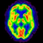 FDG PET in a normal 83-year-old shows normal metabolism in the brain cortex, basal ganglia, & thalami. (Courtesy N. Foster, MD & the University of Michigan PET Center.)