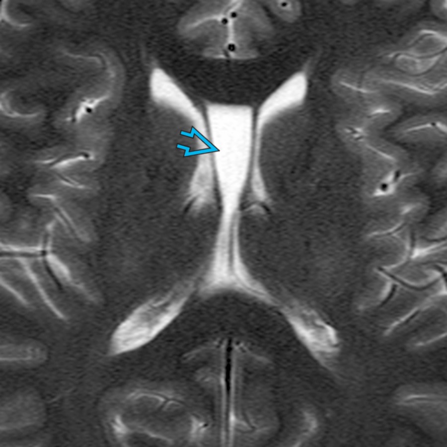 Axial T2 MR shows cavum septi pellucidi between the leaves of the septum pellucidum . Although seen incidentally, some studies have reported that CSP is frequent among athletes with a history of repeated traumatic brain injury (TBI), such as boxers and American professional football players.