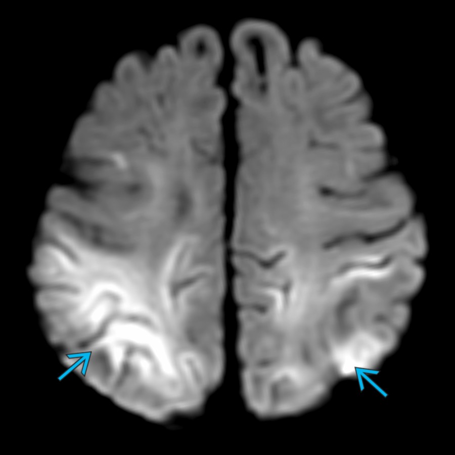 Axial DWI MR in a 2-month-old with unexplained altered mental status & seizure shows nearly symmetric diffusion restriction  in the bilateral parietooccipital regions.
