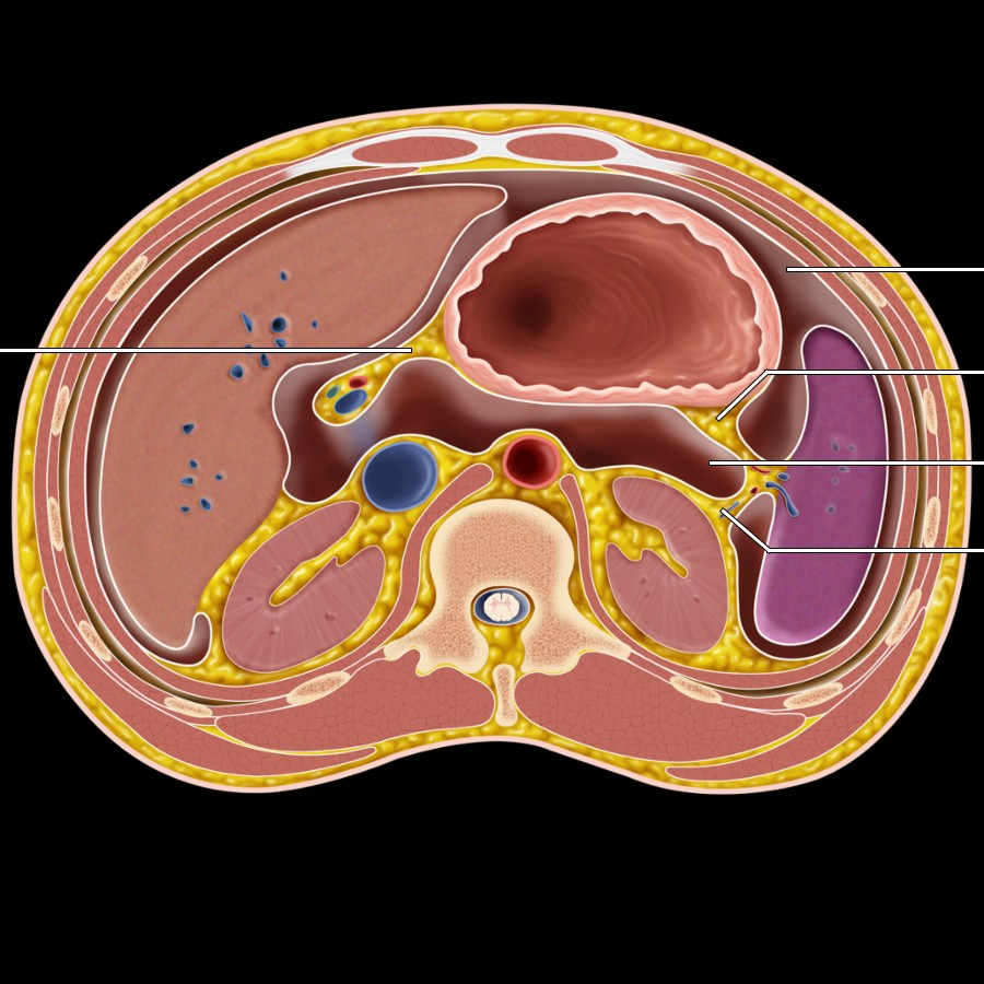 The lesser sac (omental bursa) is bordered anteriorly to the right by the lesser omentum, which conveys the common bile duct, hepatic artery, portal vein, and gastric vessels. The left borders include the gastrosplenic ligament (with short gastric vessels) and the splenorenal ligament (with splenic vessels).