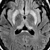 Axial FLAIR MR shows bilateral hyperintense signal in putamina and thalami from CJD.