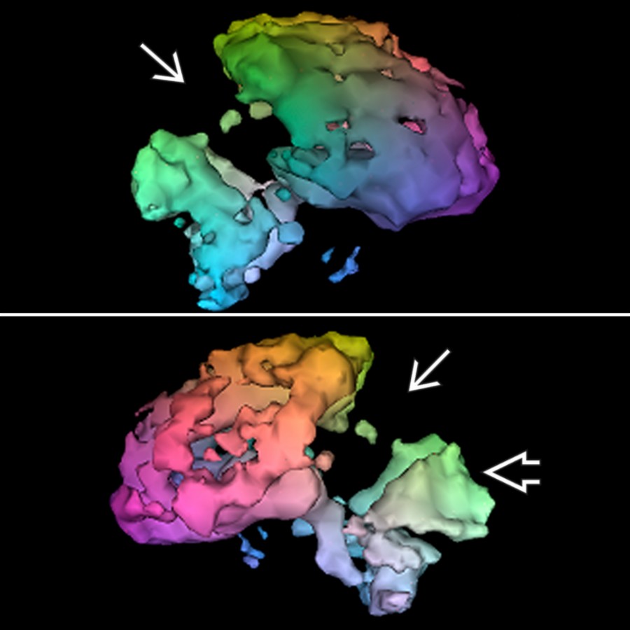Surface-rendered Tc-99m ECD SPECT in the same patient demonstrates severe reductions of parietal, temporal , and occipital cortex .