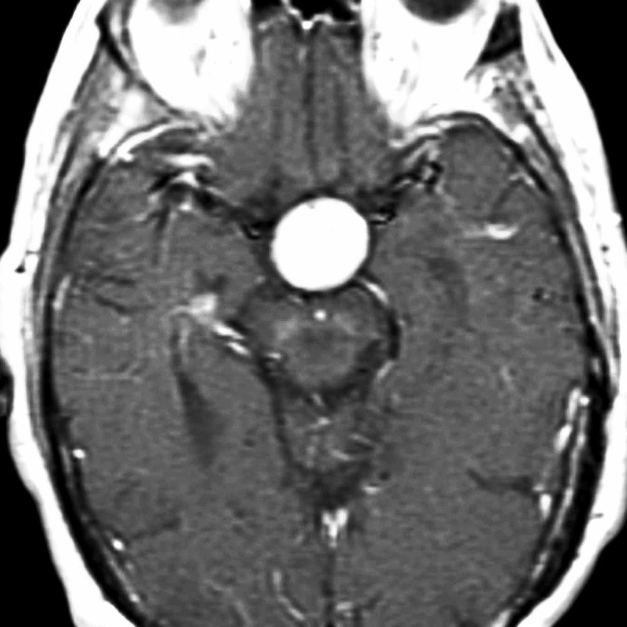Axial T1 C+ MR in the same patient shows strong, uniform enhancement of the pituicytoma, which is common in these tumors. True pituicytomas are rare tumors that arise from pituicytes in the posterior pituitary gland or infundibular stalk. Pituicytes are specialized glial cells of the posterior lobe and stalk.
