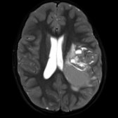 Axial T2 TSE FS MR shows a heterogeneous mass in a periventricular location . Supratentorial ependymomas are thought to arise from periventricular ependymal rests.