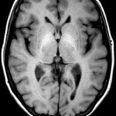 Axial T1WI MR shows hyperintensity in the GP  related to iron deposition in this patient with ACP.