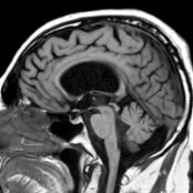 Sagittal T1 MR shows large lateral ventricles , thinning of the corpus callosum , and a relatively normal 4th ventricle  in a patient with iNPH.