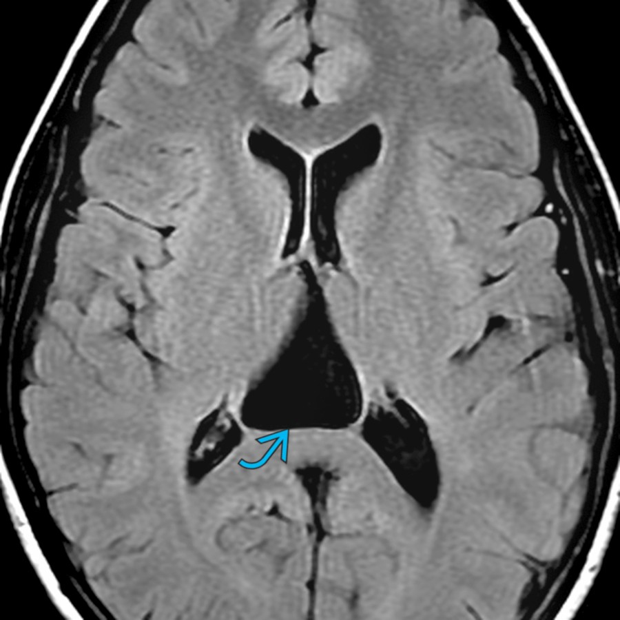 Axial FLAIR MR in the same patient shows complete suppression of the CSF signal within the cyst  similar to the lateral ventricles. Findings are consistent with a classic cavum velum interpositum. FLAIR and DWI distinguish between cavum velum interpositum and an epidermoid cyst.