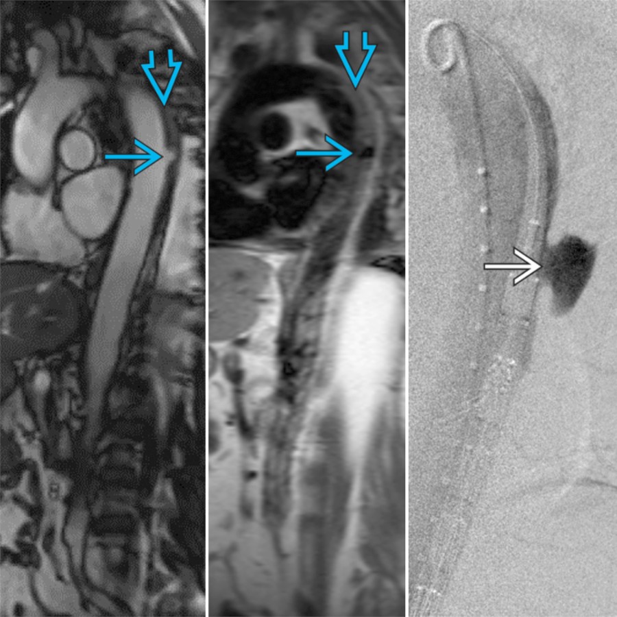 SSFP (left) and T1W (middle) MR images in a 67-year-old woman with chest pain and history of anaphylaxis with iodinated contrast shows a small PAU in the descending thoracic aorta  with surrounding IMH . Angiogram prior to stent placement (right) shows the PAU . (Courtesy S. Kligerman, MD.)