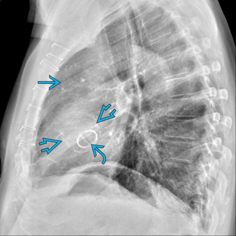 Lateral radiograph shows a prosthetic aortic valve  with surrounding calcification of the aortic root and AA . A portion of the more superior AA can be partially visualized due to atherosclerosis and adjacent surgical clips from prior aortotomy .