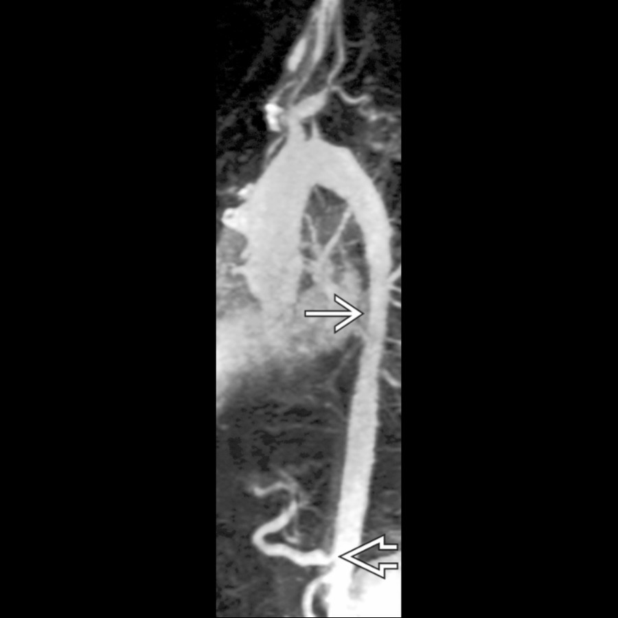 Sagittal oblique MIP MRA in a patient with Takayasu arteritis shows tapered narrowing of the mid-descending thoracic aorta . Celiac artery origin stenosis is also present .