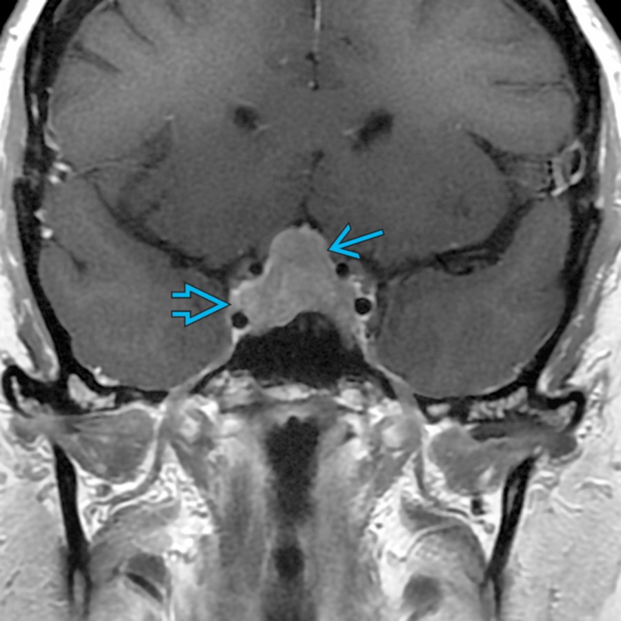 Coronal T1 C+ FS MR shows a large sellar and suprasellar mass  with extension along the superior right cavernous carotid artery, suggesting possible cavernous sinus invasion .