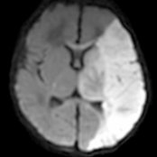 Axial DWI MR in a 4-day-old term neonate presenting with seizures shows diffusion restriction  throughout the left middle cerebral artery (MCA) territory, consistent with a perinatal arterial ischemic stroke (PAIS).