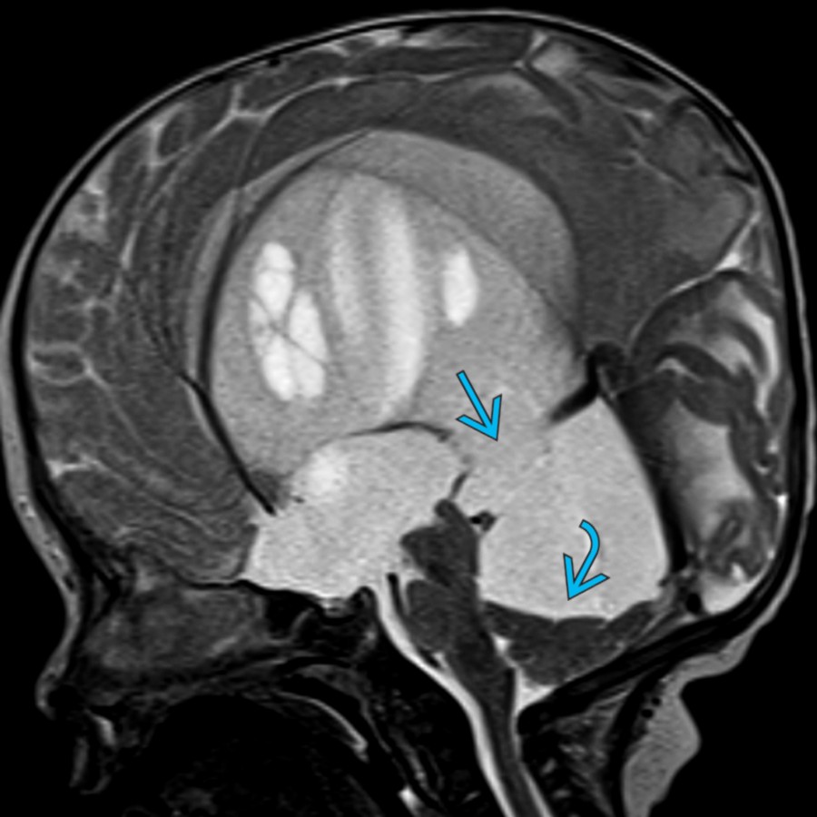 Sagittal T2 MR in a child with hydrocephalus shows markedly enlarged ventricles. The left lateral ventricle herniates through the medial wall of the atria, through the quadrigeminal plate cistern  and compresses the cerebellum inferiorly below the tentorium .