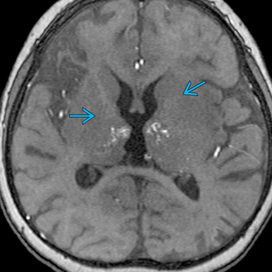 Axial TOF MRA in a 2 year old with multiple infarcts of various ages shows multiple small areas of flow-related signal  in the bilateral thalami, consistent with lenticulostriate collaterals of moyamoya.