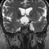 Coronal T2 MR in a 48-year-old man who presented with visual changes shows a cystic suprasellar mass  with a focal T2-hypointense nodule  . The T2 imaging mimics a Rathke cleft cyst.