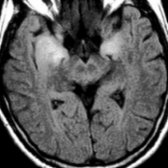 Axial FLAIR MR in a patient with subacute dementia and lung cancer shows hyperintensity within the medial temporal lobes, classic for limbic encephalitis. Imaging mimics herpes encephalitis.
