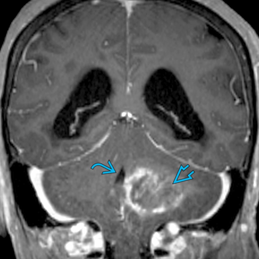 Coronal T1 C+ MR in a patient presenting with headache and ataxia demonstrates a large heterogeneously enhancing mass  in the left cerebellum with mass effect and effacement of the 4th ventricle . Biopsy revealed a glioblastoma.