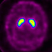 Axial I-123 ioflupane SPECT shows normal putamen activity  and caudate activity . These finding are not consistent with Parkinson disease (PD) or atypical parkinsonism syndromes (APS).