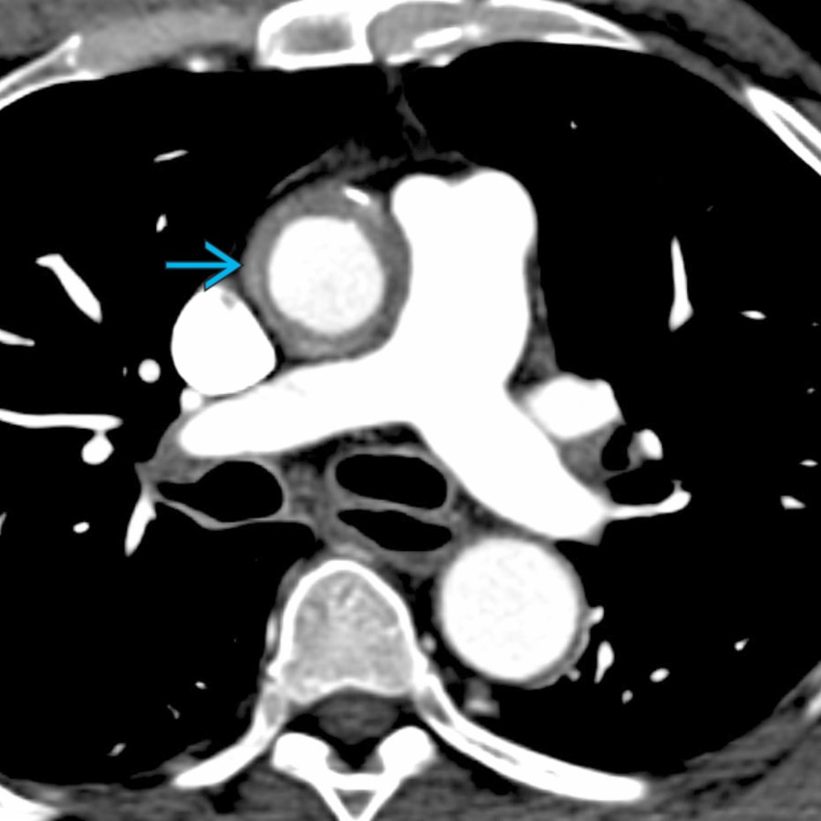 Axial CECT shows the circumferential ascending aortic soft tissue . The imaging finding were called an IMH on CT. The patient was taken for surgery and a Bentall procedure was performed. Pathology showed IgG4 sclerosing periaortitis. There was no IMH.