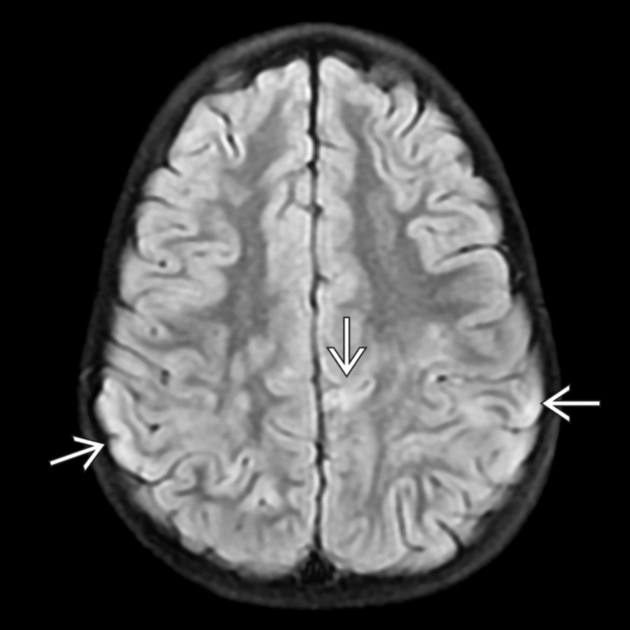 Axial FLAIR MR in a 4-year-old with severe onset of encephalopathy with positive MOG antibody titer depicts several areas of abnormal cortical hyperintensity and edema  as well as subcortical white matter signal abnormalities.