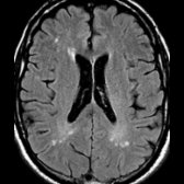 Axial FLAIR in a 72-year-old man shows scattered white matter hyperintensities . Aging brains may demonstrate a few scattered nonconfluent white matter hyperintensities. Increased prevalence of white matter hyperintensities with cardiovascular risk factors such as diabetes & hyperlipidemia is shown.
