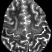 Axial T2WI FS MR shows central cortical hypointense signal intensity    in the precentral gyri due to iron deposition. While this is common in ALS patients, it is nonspecific and may be seen in older patients due to iron and heavy metals accumulation.