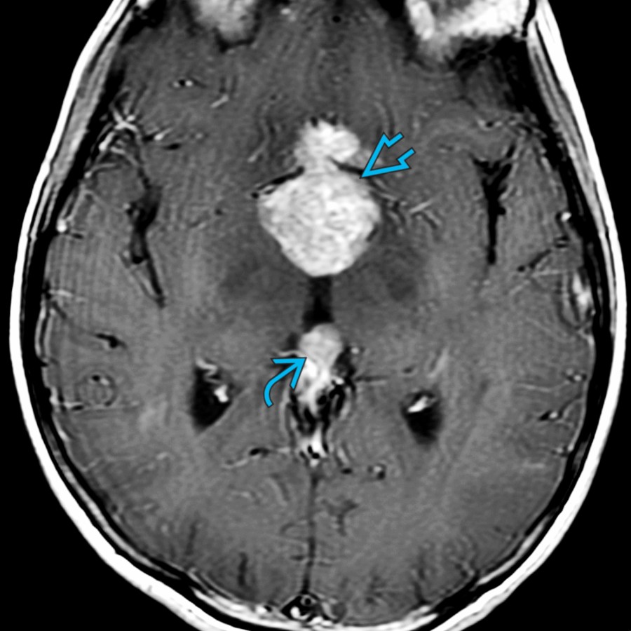 Axial T1 C+ MR in the same patient shows enhancing masses of the pineal  and suprasellar  related to CSF spread of germinoma. These masses are hyperdense on CT. The combination of suprasellar and pineal mass is sometimes called double midline germinoma and occurs in ~ 20% of cases.
