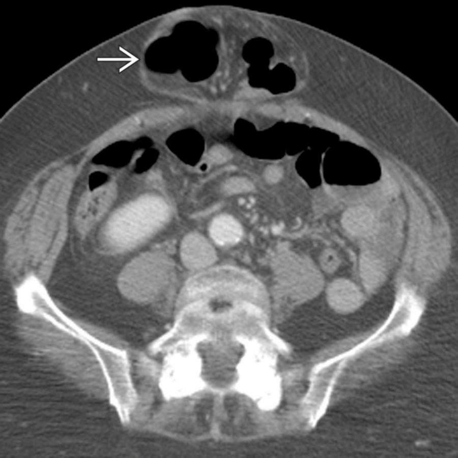 Axial CECT demonstrates protrusion of the transverse colon through a defect in the abdominal wall at the midline, representing an umbilical hernia . There is no sign of obstruction nor infarction of the herniated fat, 2 of the common complications of abdominal wall hernias.