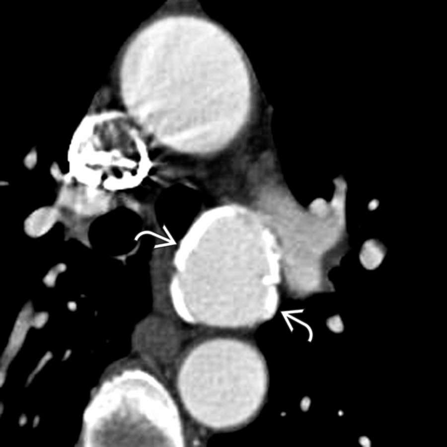 Axial chest CTA in the same patient reveals extensive calcifications  along the wall of the pseudoaneurysm. This constitutes the most common imaging appearance of CTAI. The presence of other stigmata of trauma is often helpful to differentiate from ductus aneurysm.