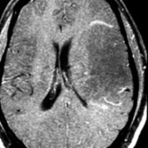 Axial T1 C+ MR demonstrates a large, tumefactive, hypointense lesion with minimal partial peripheral enhancement. Less mass effect is present than expected for lesion size. More lesions were seen elsewhere.